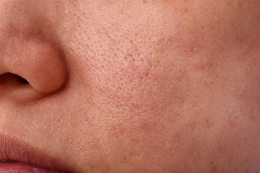 Kulit Kusam & Tidak Merata